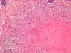 Lupus miliaris disseminatus faciei/pathology