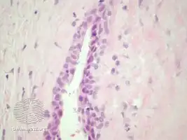 pathology-Median raphe cyst