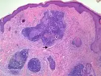 Trichoepithelioma-pathology