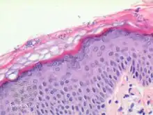 Histology: Malassezia spores (S) and filaments in outer skin layer