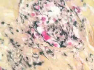 Mucicarmine stain: bright pink cryptococcosis capsule