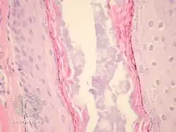 pathology-Prurigo pigmentosa