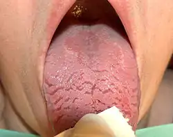 Fissured tongue combined with geographic tongue