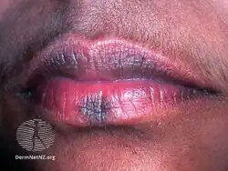 Fixed drug reaction (pigmented) on lip