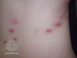 Flea bites