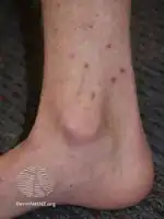 Flea bites