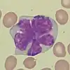 Lymphoma cell