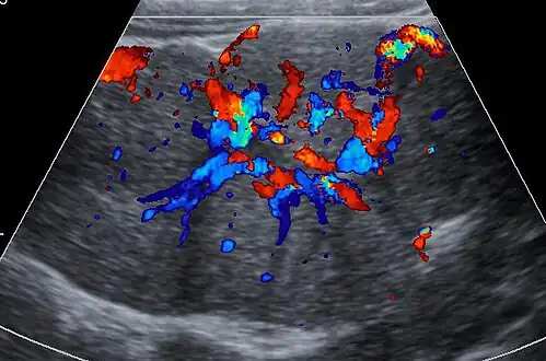 Ultrasound of malformed vessels within the fibrous scar of FNH.