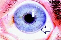 Four examples of cholesterol deposits at the outer edge of the cornea.