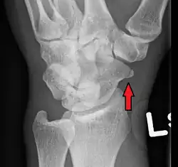 Fracture of the tubercle of the scaphoid bone of the wrist