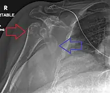 Fracture dislocation of the right shoulder