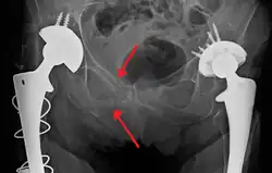 Fractures of the superior (in two places) and inferior pubic rami on the person's right, in a person who has had prior hip replacements