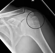 Fracture of the greater tuberosity of the humerus
