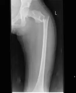 Break through simple bone cyst in the long bone of the thigh, near the hip.