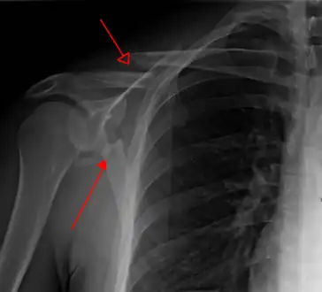 X-ray showing a fracture of the clavicula and scapula