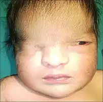 Image of infant with Fraser Syndrome