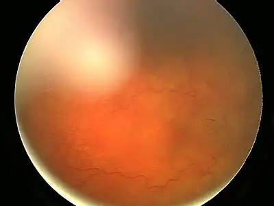 Fundal photograph showing severe papilloedema in the right eye.