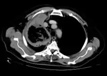 CT scan chest of person treated for acute myeloid leukaemia, presented with cough, fever and shortness of breath.