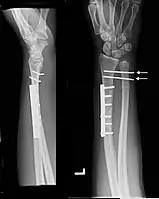 Galeazzi fracture after surgical fixation