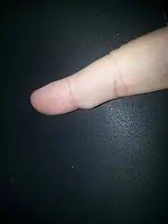 Small cyst on right index finger