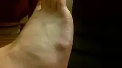 Cyst on dorsum of right foot