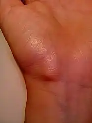 Ganglion cyst on the palmar side of the left wrist