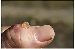small cyst on thumb lanced with red-hot needle
