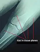 Plain X-Ray of a patient with gas gangrene of left leg