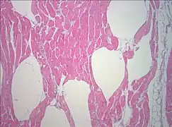 Muscle biopsy examined under the microscope (haematoxylin-eosin stain, zoom 100×): the large white areas between the muscle fibers are due to gas formation.