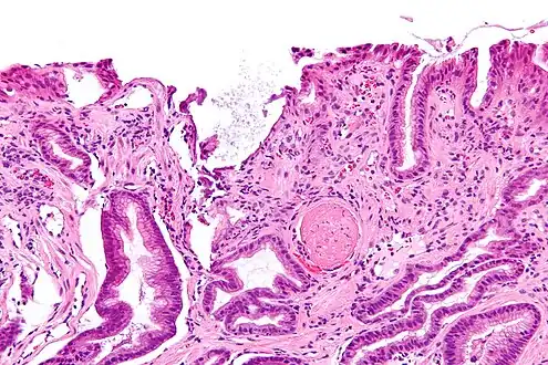 Micrograph showing gastric antral vascular ectasia. A large spherical, eosinophilic (i.e. pink) fibrin thrombus is seen off-center right. Stomach biopsy. H&E stain.