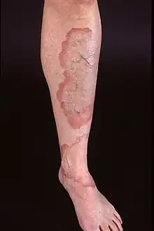 Large, well demarcated plaques with red, active borders, all located on the lower leg of an adult