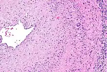 Intermediate magnification micrograph showing giant cell arteritis in a temporal artery biopsy. The arterial lumen is seen on the left. A giant cell is seen on the right at the interface between the thickened intima and media. H&E stain