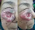 Giant squamous cell carcinoma of the cheek