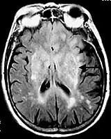 Axial fluid-attenuated inversion recovery MRI image demonstrating tumor-related infiltration involving lenticular nuclei (Arrow).