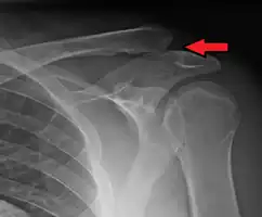 Type 3 AC joint separation on plain X ray
