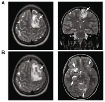 A: T2-weighted MRI showing liquefied, necrotic brain tissue as a result of GAE caused by Balamuthia mandrillarisB: T1-weighted MRI showing expansion and addition of necrotic areas 4 days later