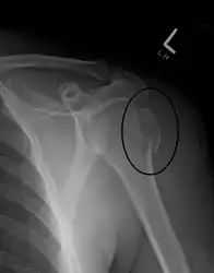 A fracture of the greater tuberosity as seen on AP X ray