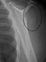 A fracture of the greater tuberosity of the humerus