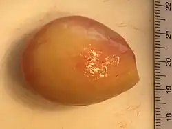 Gross pathology of a peritoneal loose body, caused torsion and autoamputation of an epiploic appendage, which eventually becomes embedded in a fibrous capsule.
