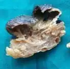 Gross pathology of a cystic nodular hidradenoma