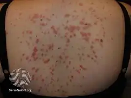 Guttate psoriasis