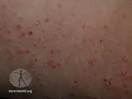 Guttate psoriasis