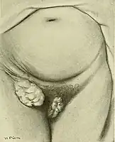 Drawing of cancer of the clitoris with spread to the groin