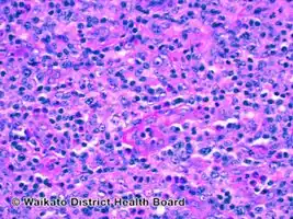 Angioimmunoblastic T-cell lymphoma-pathology
