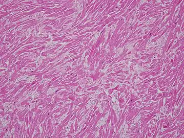 Stained microscopic section of heart muscle in hypertrophic cardiomyopathy