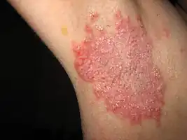 Right armpit skin affected during Hailey-Hailey disease flare