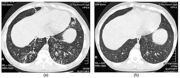 High resolution computed tomography (HRCT) images of the lower chest in a 16-year-old boy initially diagnosed with DPB (left), and 8 weeks later (right) after a 6-week course of treatment with erythromycin. The bilateral bronchiectasis and prominent centri-lobular nodules with a "tree-in-bud" pattern shows noticeable improvement.