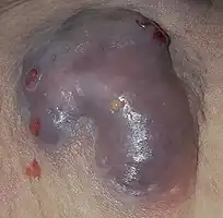 This lesion is about 4 inches across
