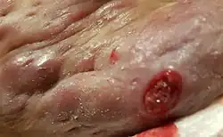 Stage III open lesions