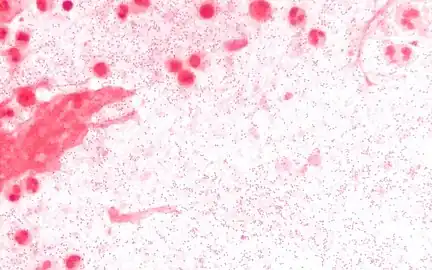 Sputum Gram stain at 1000x magnification. The sputum is from a person with Haemophilus influenzae pneumonia, and the Gram negative coccobacilli are visible with a background of neutrophils.